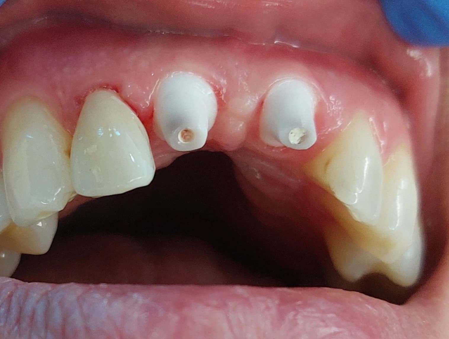 زراعات سيراميك SDS